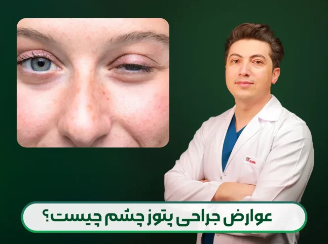 عوارض عمل پتوز چشم