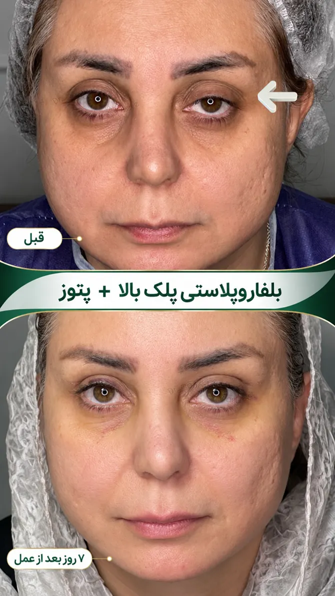 عمل پتوز چشم
