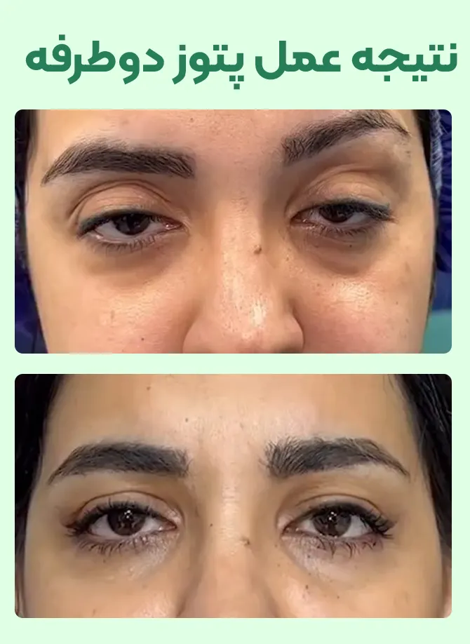 عمل پتوز دوطرفه