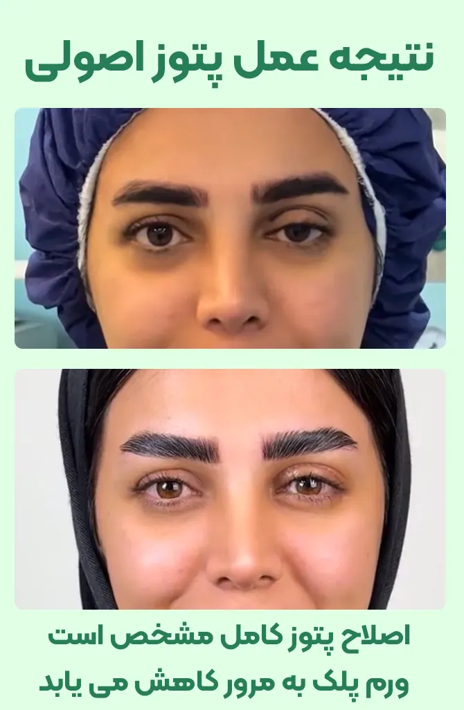 عمل پتوز چشم