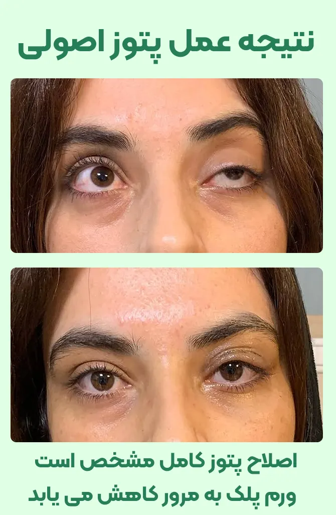 نتیجه جراحی پتوز