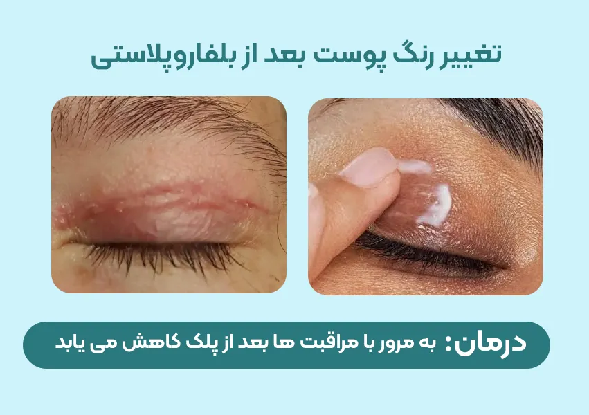 تغییر رنگ پوست بعد از بلفاروپلاستی