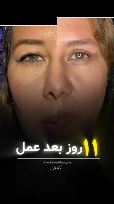 نتیجه بلفاروپلاستی بعد 11 روز
