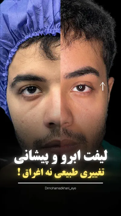 لیفت اندوسکوپ پیشانی و ابرو