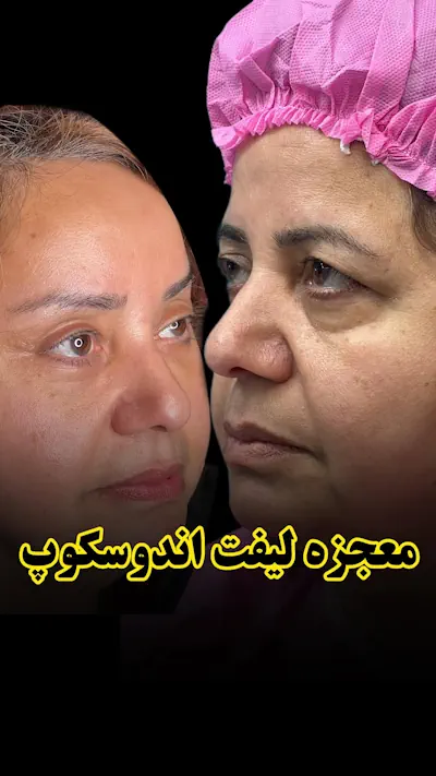 معجزه لیفت اندوسکوپ صورت