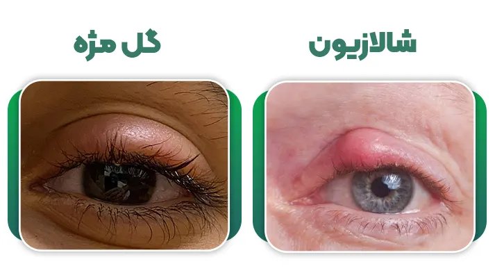 تفاوت شالازیون با گل مژه