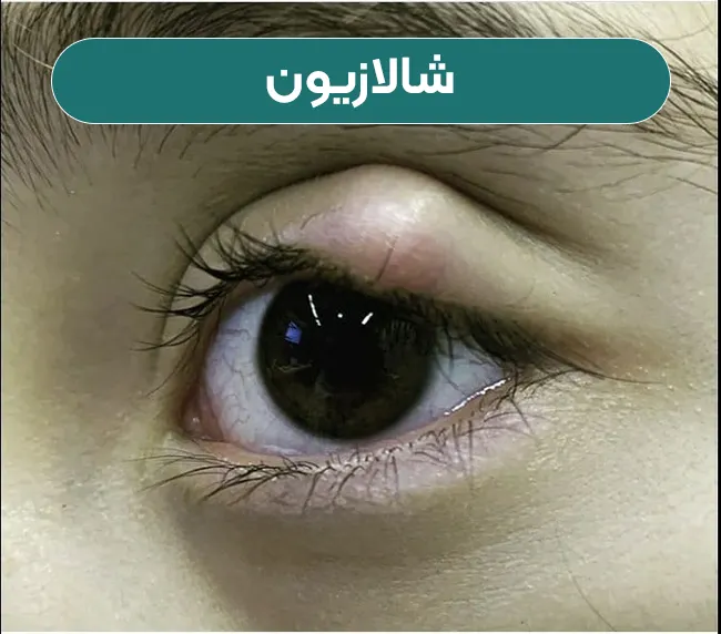 شالازیون
