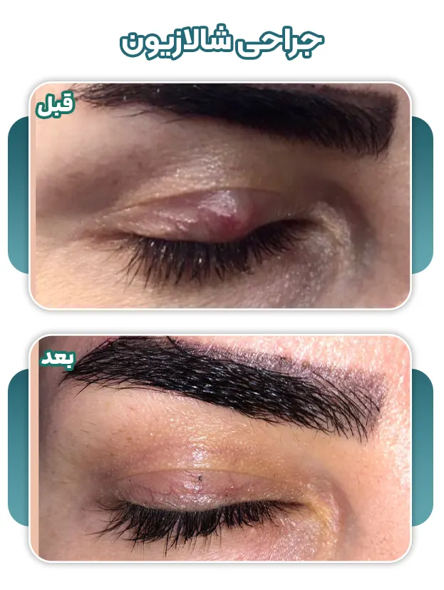 جراحی شالازیون