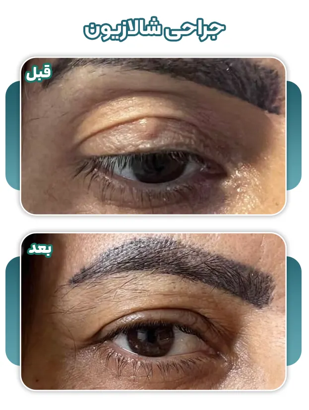 جراحی شالازیون قبل و بعد