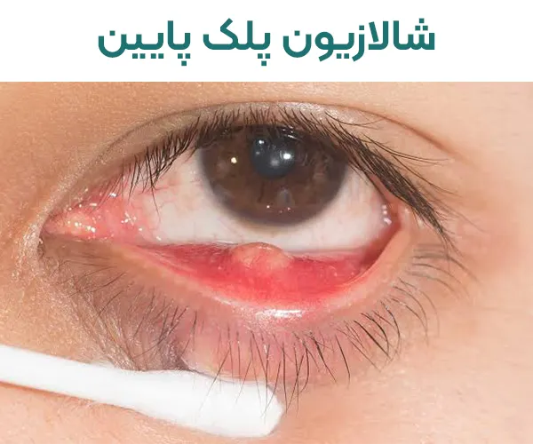 شالازیون پلک پایین