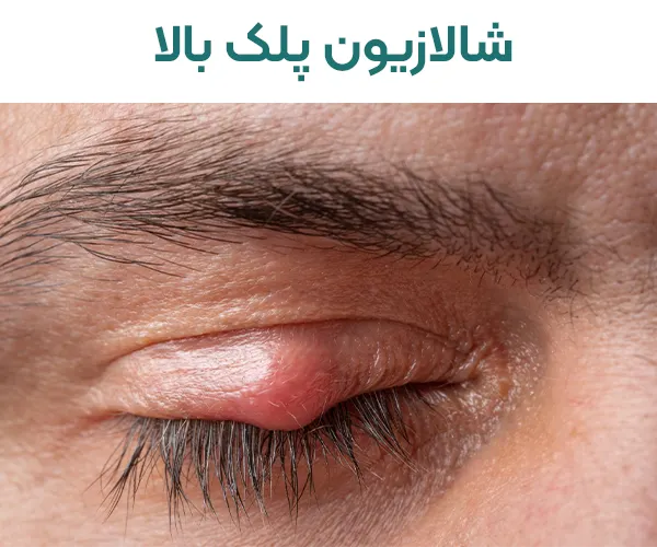 شالازیون پلک بالا